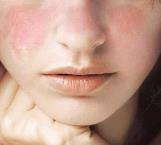 ¿Cuáles son los síntomas más comunes del lupus?