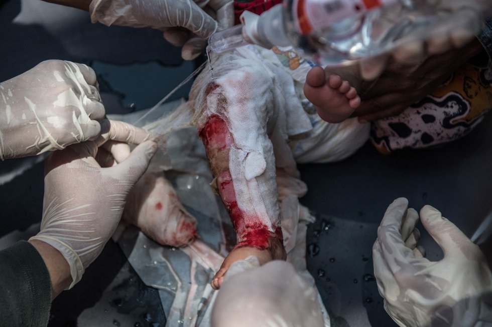 Doctores reemplazan las gasas en la herida de una niña a las afueras de un hospital en Palu. CARL COURT GETTY IMAGES